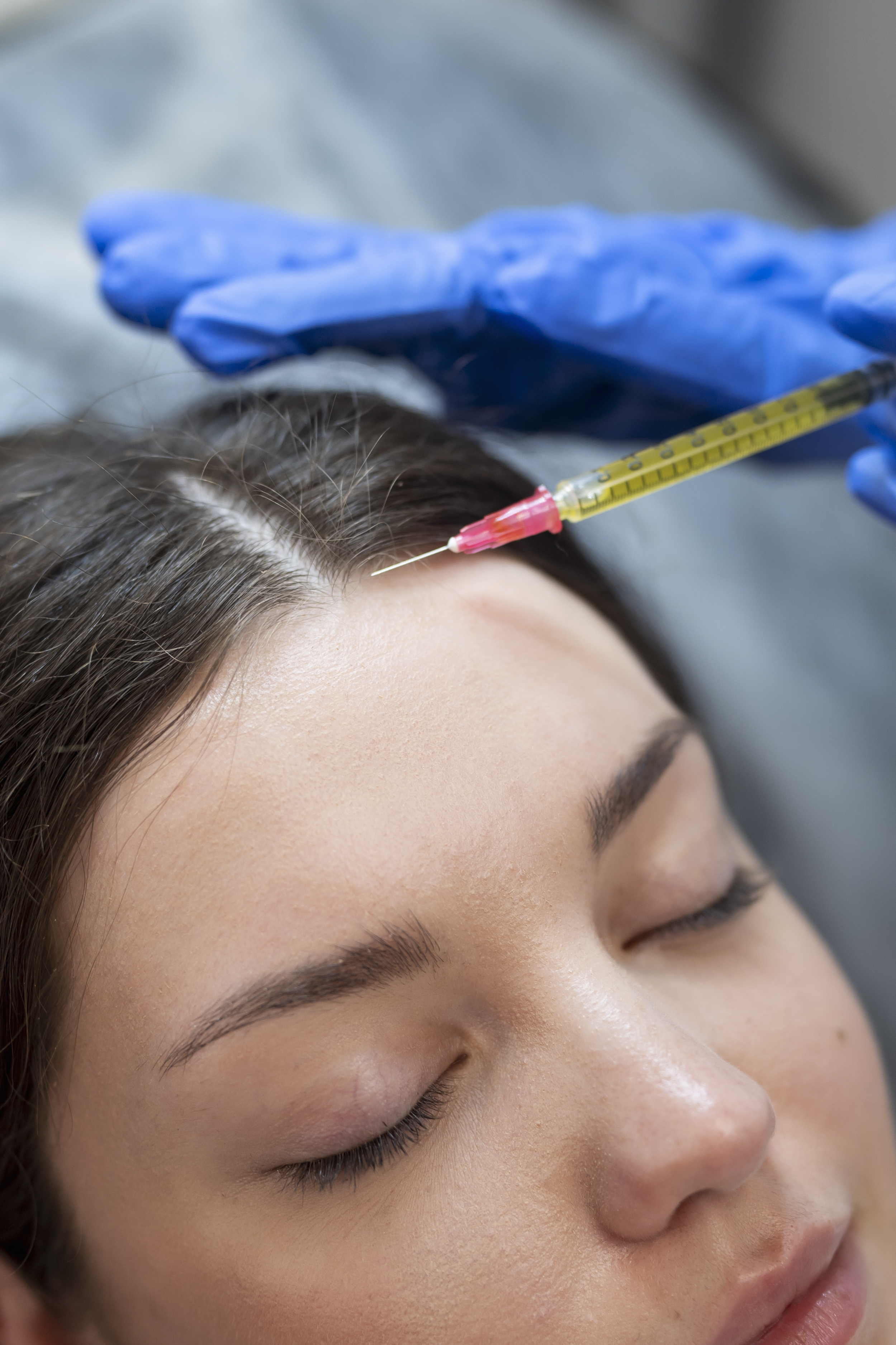 Scalp Microneedling
